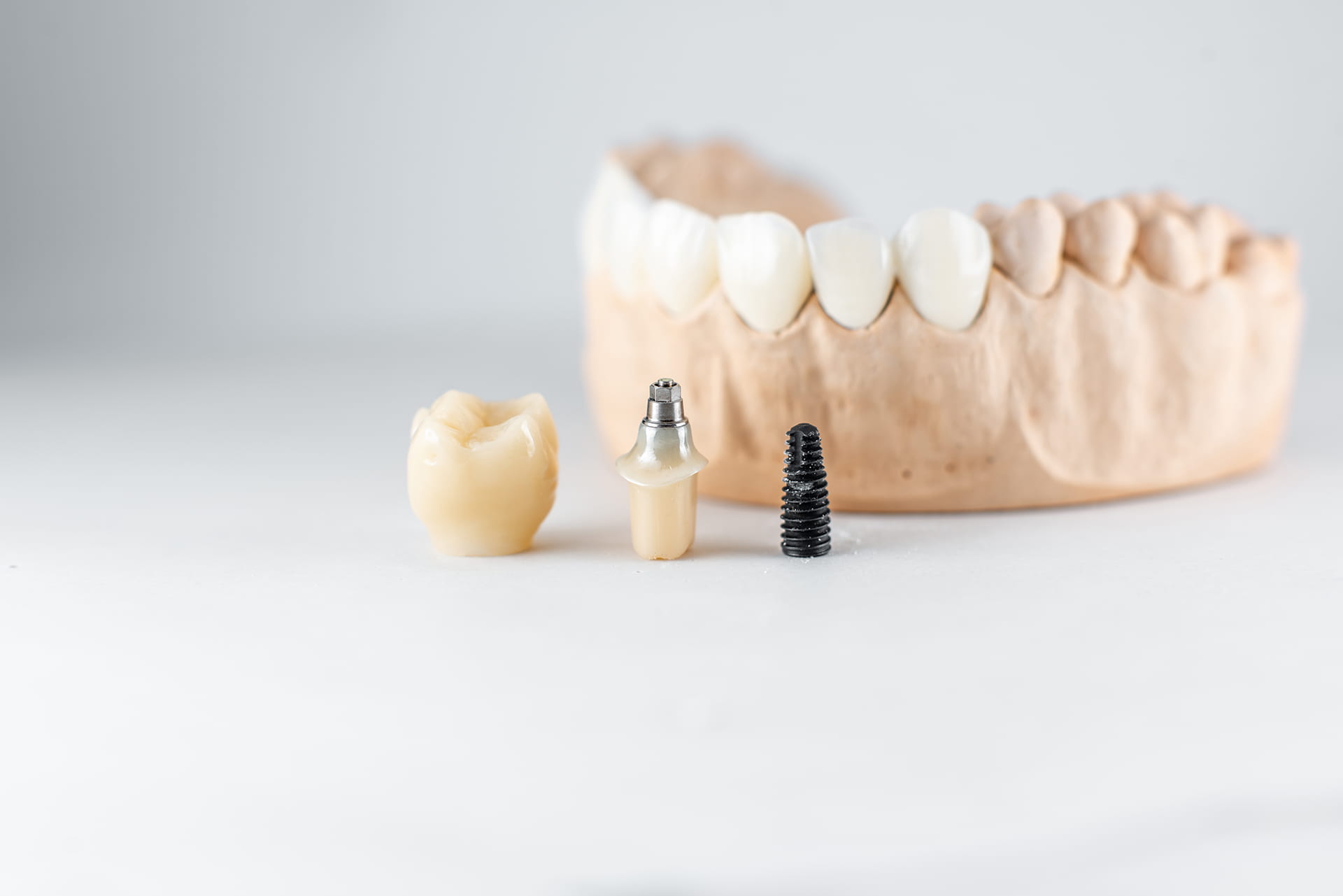 All-on-4 Dental Implants – A Game Changer for Your Smile