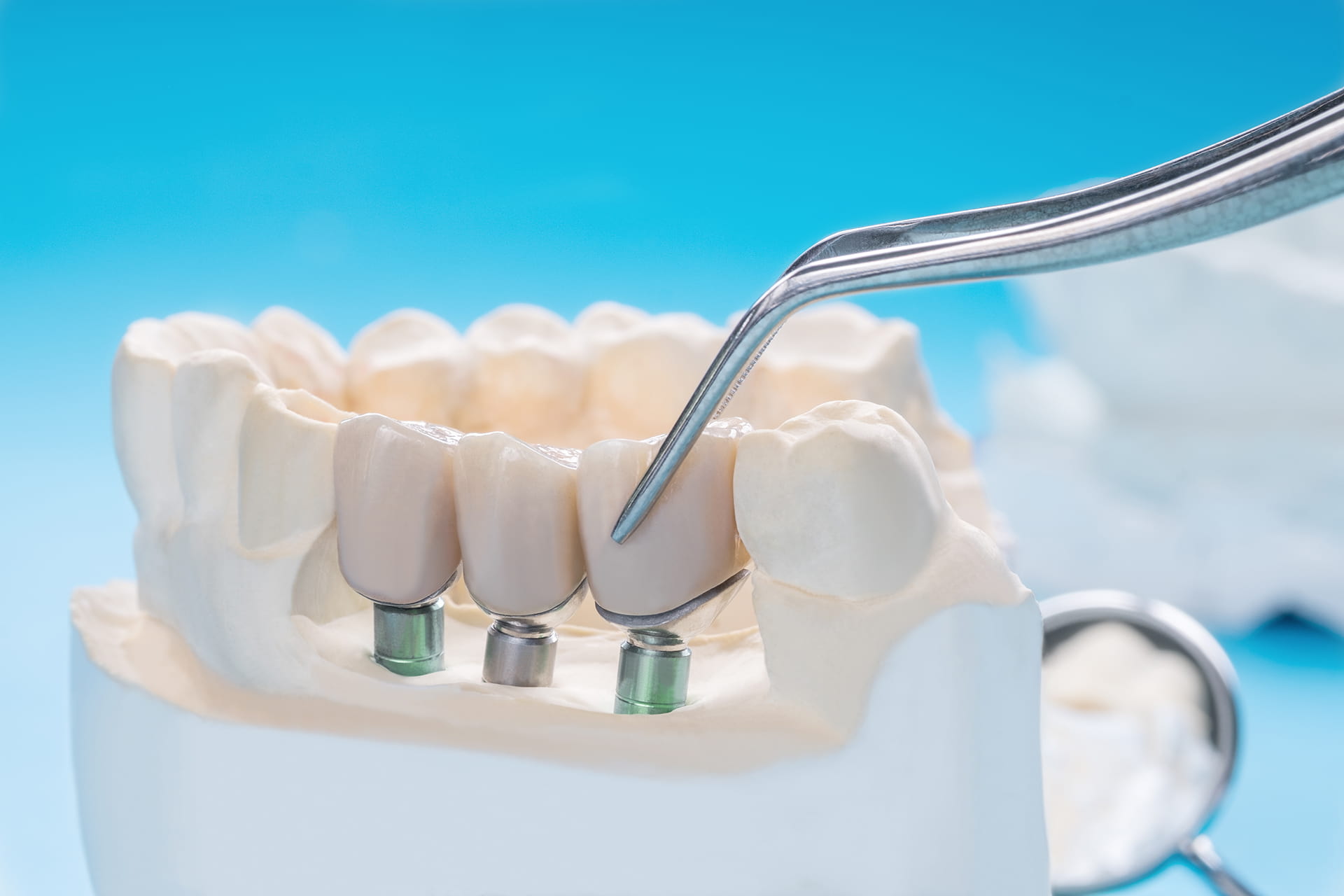 Exploring the World of Dental Implants- Types, Costs, and More