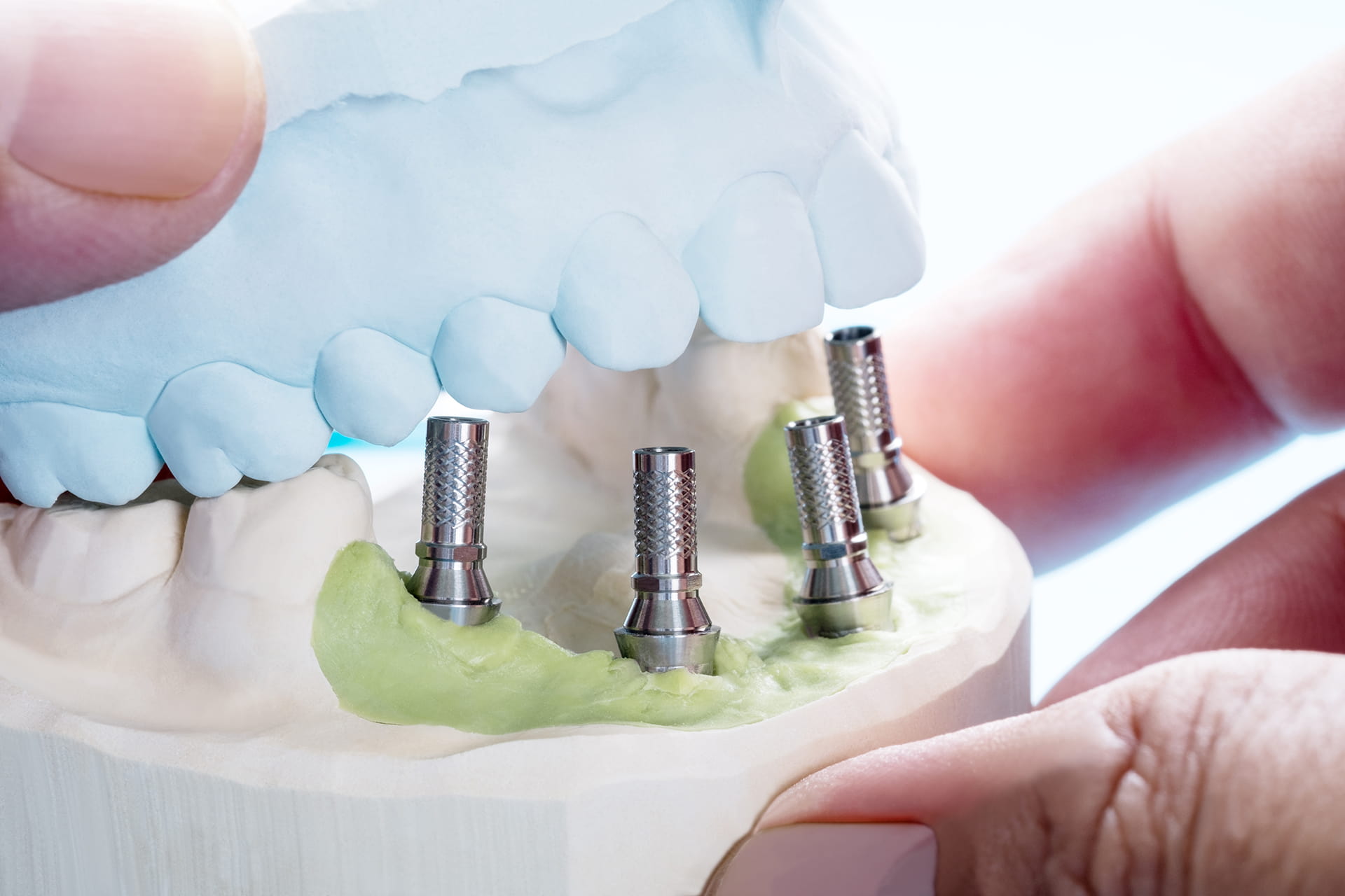 Discovering All-On-4 Dental Implants- A Revolution in Smile Restoration