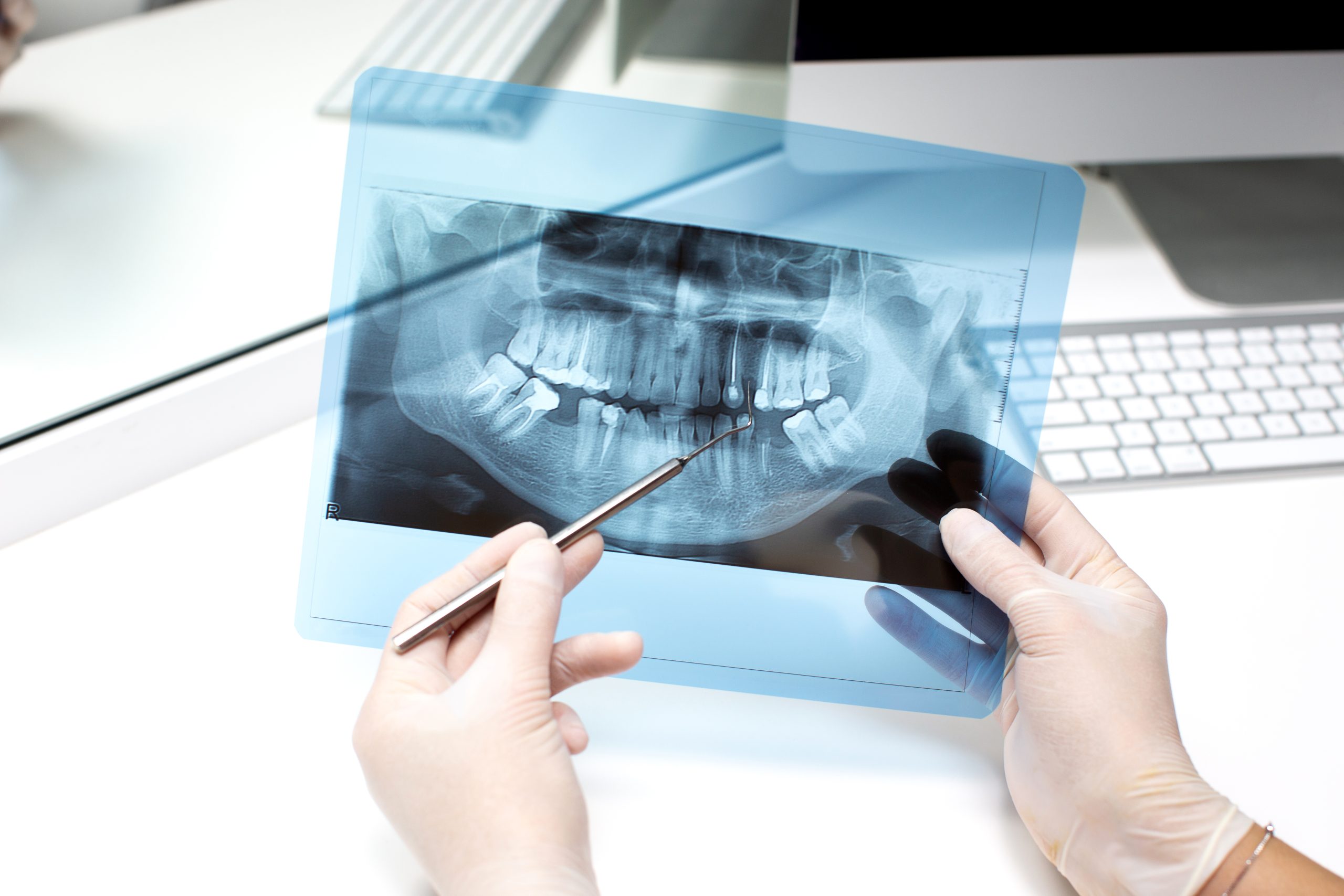 Dental Bone Graft: Procedures, Benefits, and What to Expect